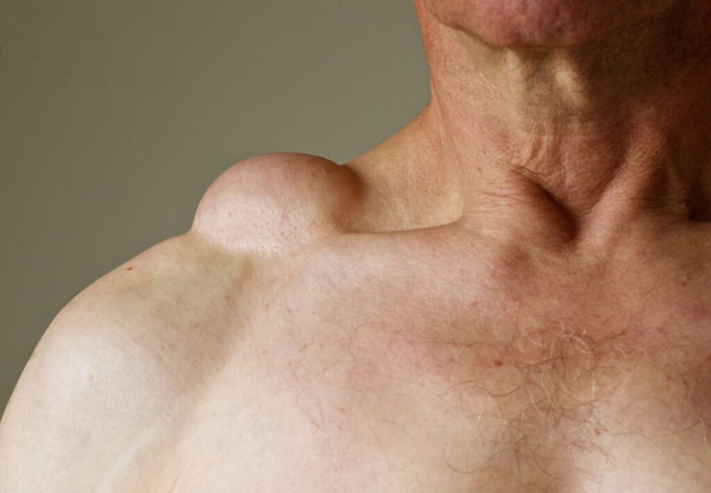 Lipoma Removal Surgery in Delhi